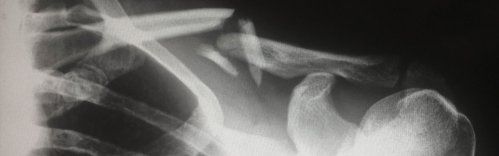 Recuperación hombro Santander